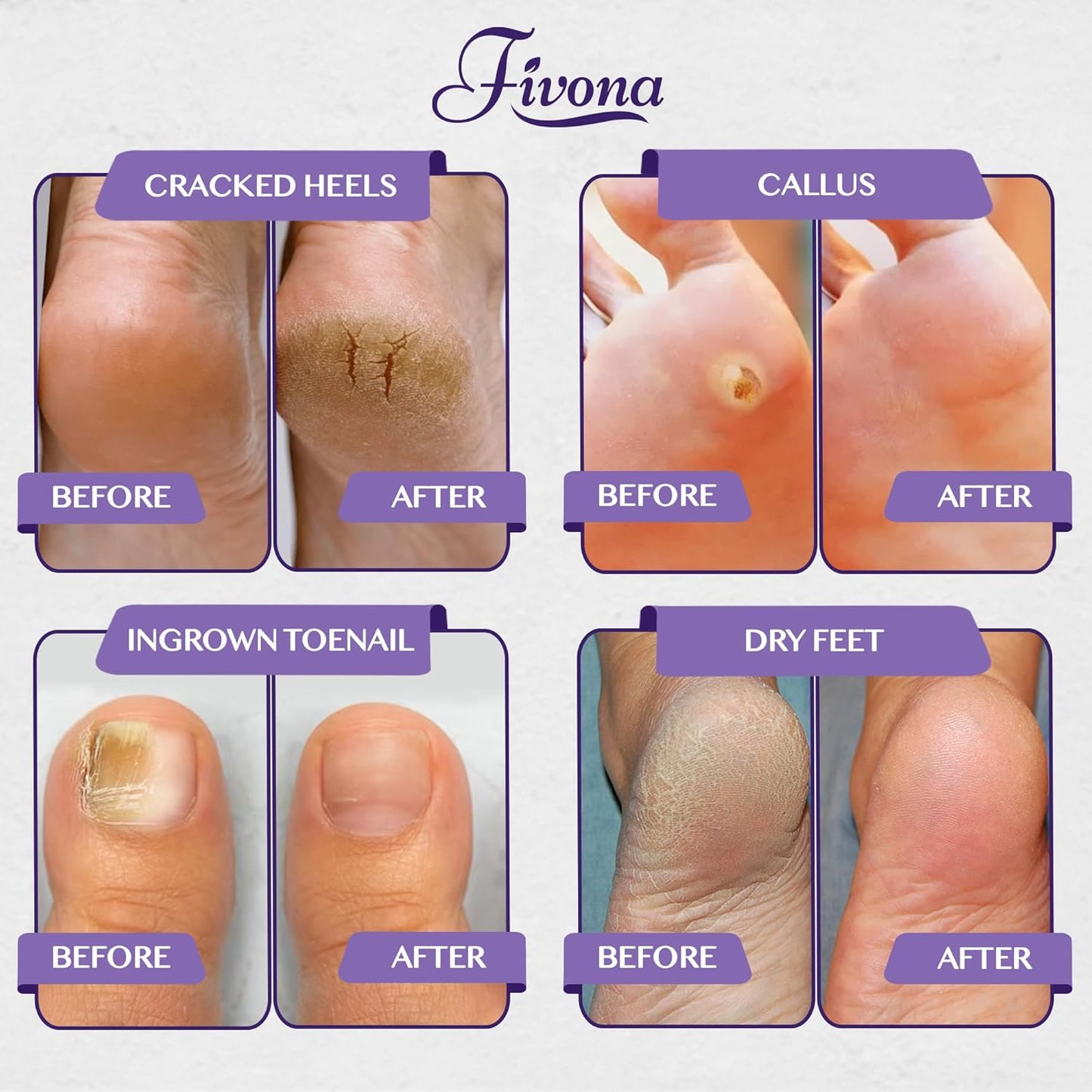 Before and After Using Foot Soak Blend Epsom Salt with Lavender